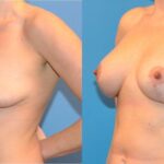 Breast Augmentation & Lift #13 - Before and After