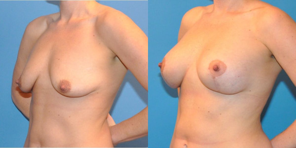 Breast Augmentation & Lift #13 - Before and After