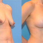 Breast Augmentation & Lift #13 - Before and After