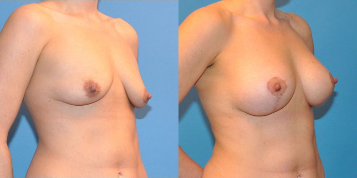 Breast Augmentation & Lift #13 - Before and After