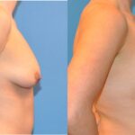 Breast Augmentation & Lift #13 - Before and After