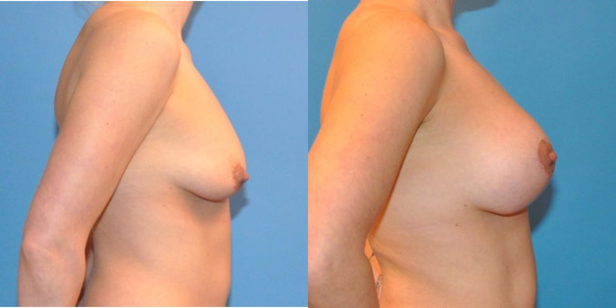 Breast Augmentation & Lift #13 - Before and After