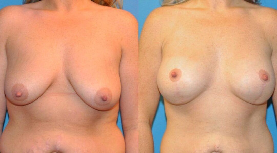 Breast Augmentation & Lift #14