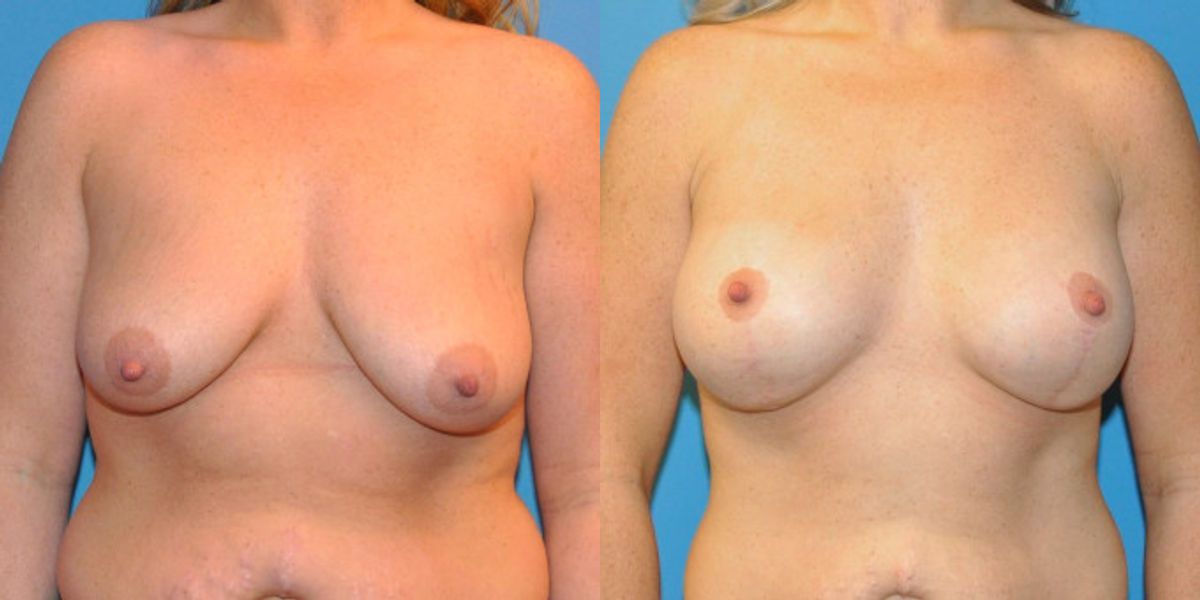 Breast Augmentation & Lift #14 - Before and After
