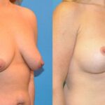 Breast Augmentation & Lift #14 - Before and After