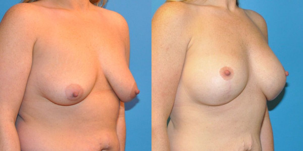 Breast Augmentation & Lift #14 - Before and After