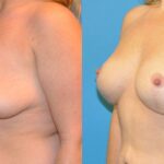 Breast Augmentation & Lift #14 - Before and After