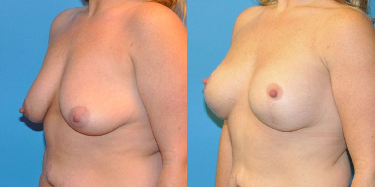 Breast Augmentation & Lift #14 - Before and After