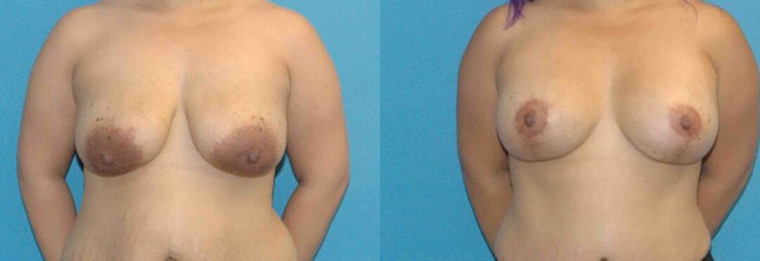 Breast Augmentation & Lift #15