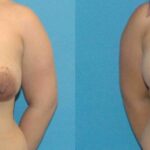 Breast Augmentation & Lift #15 - Before and After