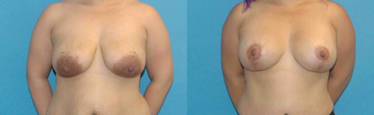 Breast Augmentation & Lift #15 - Before and After