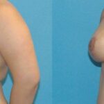 Breast Augmentation & Lift #15 - Before and After