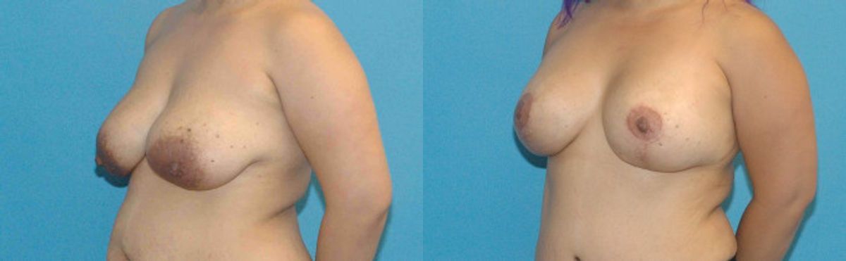 Breast Augmentation & Lift #15 - Before and After