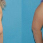Breast Augmentation & Lift #15 - Before and After
