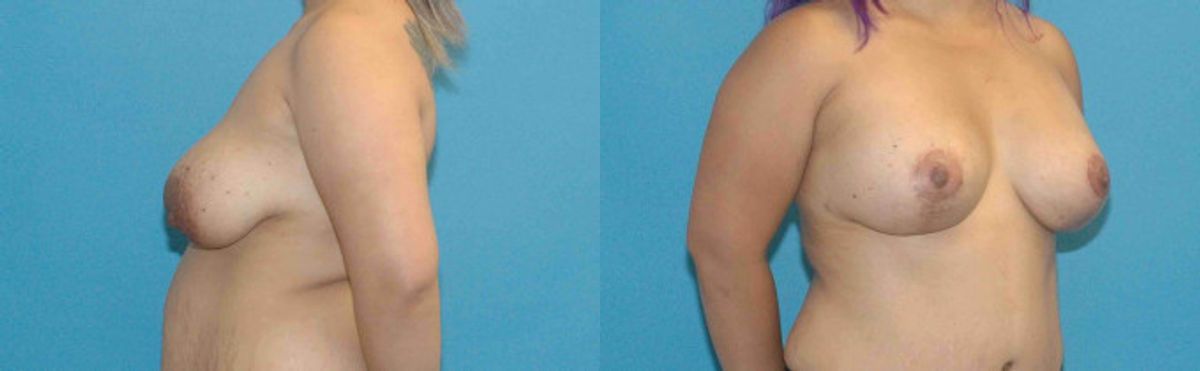 Breast Augmentation & Lift #15 - Before and After