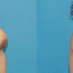 Breast Augmentation & Lift #15 - Before and After