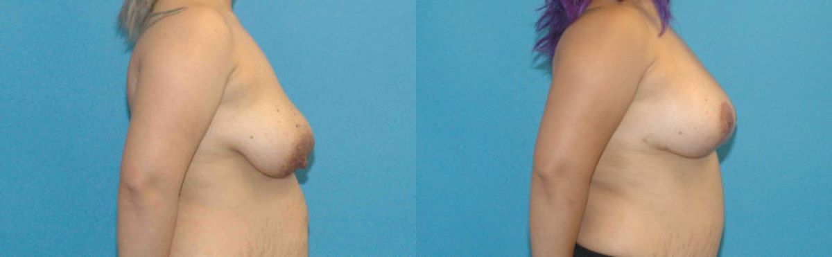 Breast Augmentation & Lift #15 - Before and After