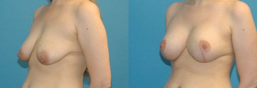 Breast Augmentation & Lift #16