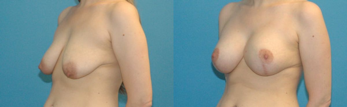 Breast Augmentation & Lift #16 - Before and After