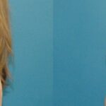 Breast Augmentation & Lift #16 - Before and After