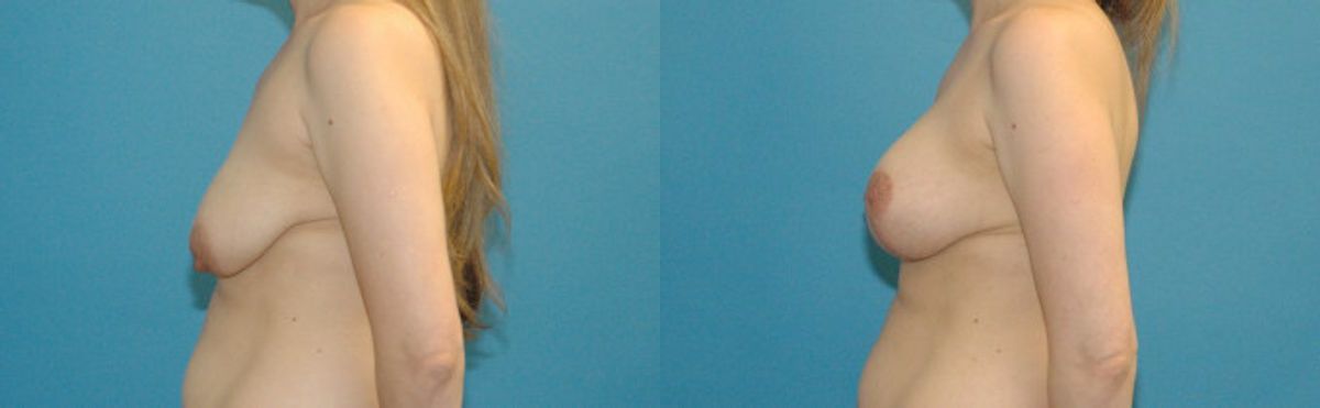 Breast Augmentation & Lift #16 - Before and After