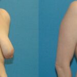 Breast Augmentation & Lift #16 - Before and After