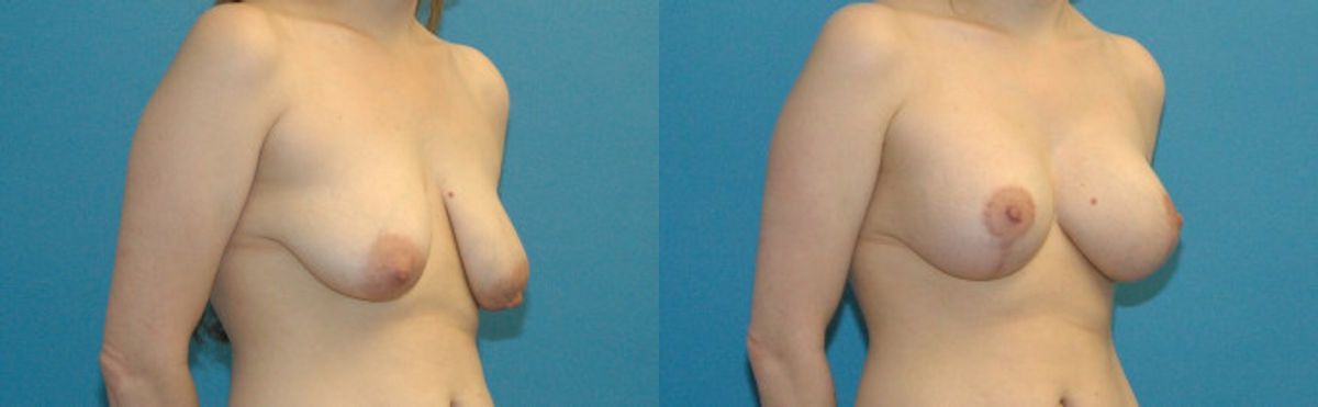 Breast Augmentation & Lift #16 - Before and After