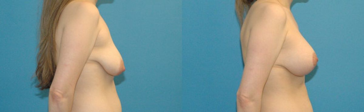 Breast Augmentation & Lift #16 - Before and After