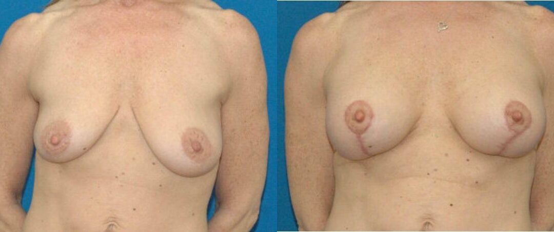 Breast Augmentation & Lift #17