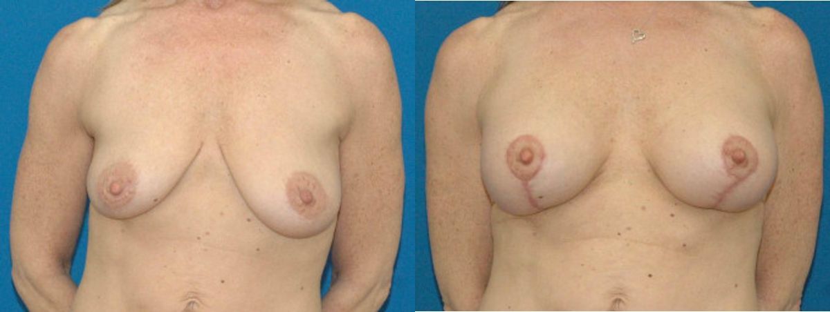 Breast Augmentation & Lift #17 - Before and After