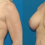 Breast Augmentation & Lift #17 - Before and After