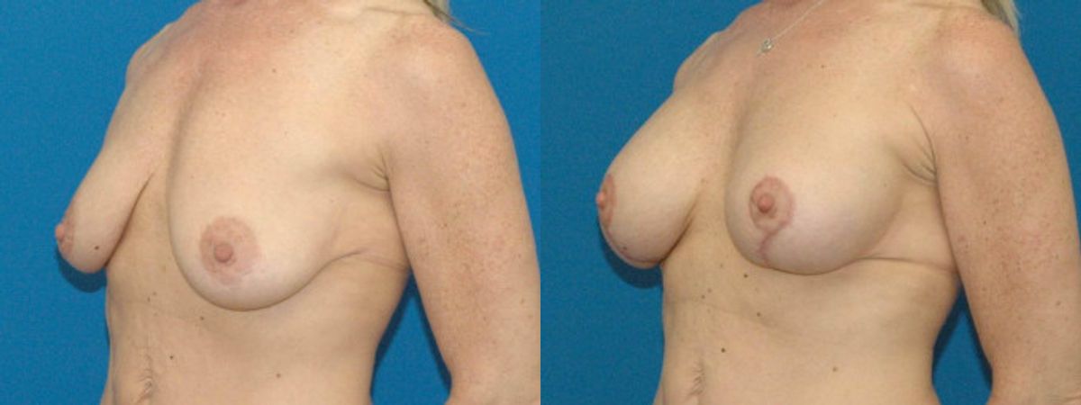Breast Augmentation & Lift #17 - Before and After
