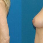 Breast Augmentation & Lift #17 - Before and After