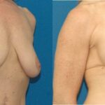 Breast Augmentation & Lift #17 - Before and After
