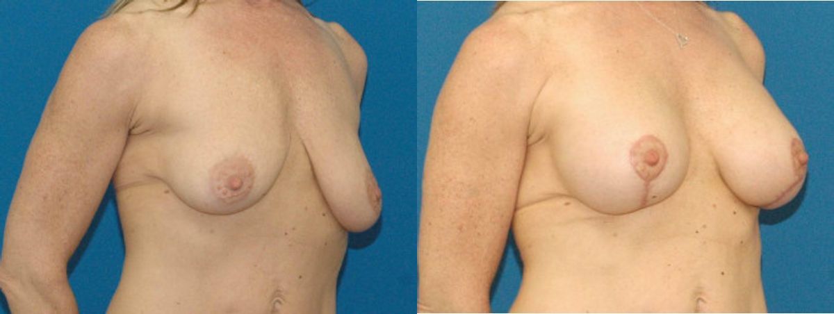 Breast Augmentation & Lift #17 - Before and After