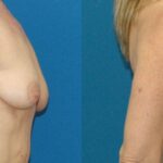 Breast Augmentation & Lift #17 - Before and After