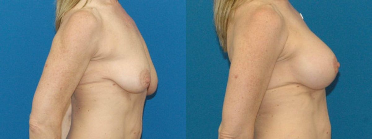 Breast Augmentation & Lift #17 - Before and After