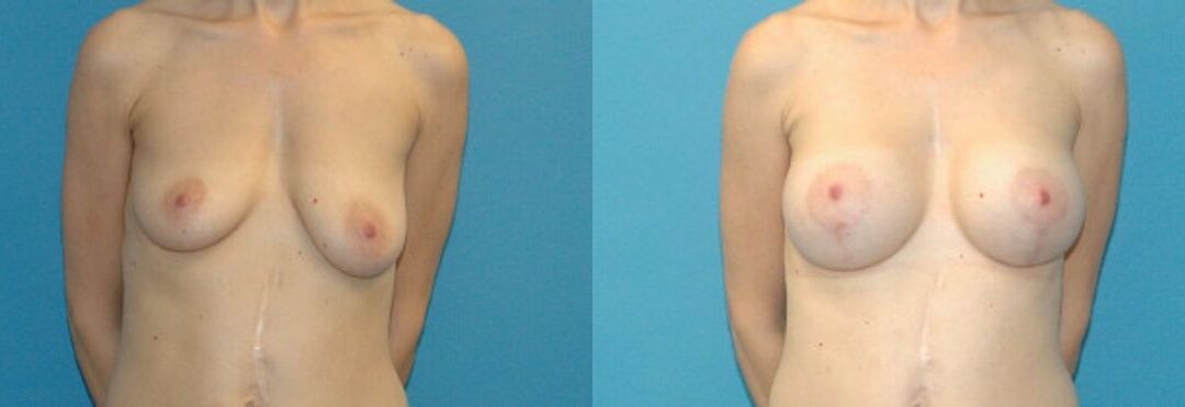 Breast Augmentation & Lift #18
