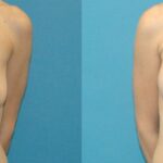 Breast Augmentation & Lift #18 - Before and After