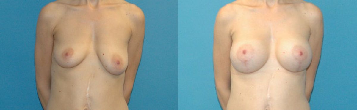 Breast Augmentation & Lift #18 - Before and After