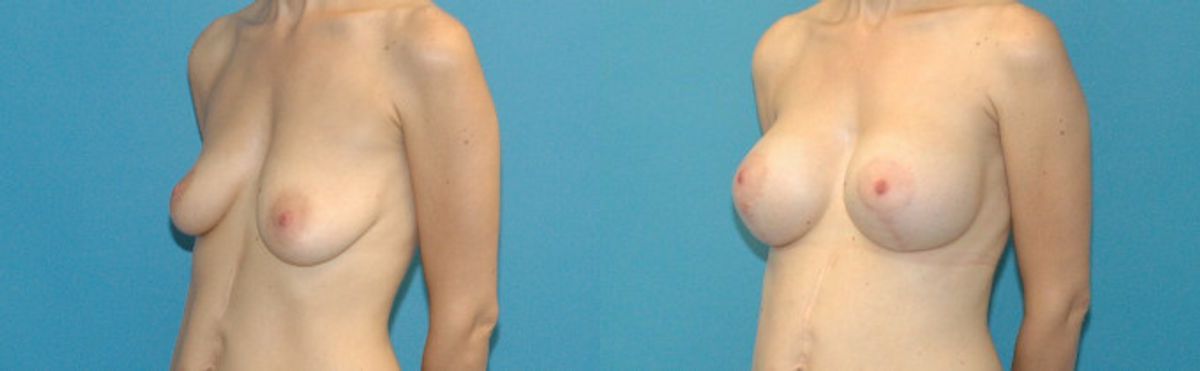 Breast Augmentation & Lift #18 - Before and After