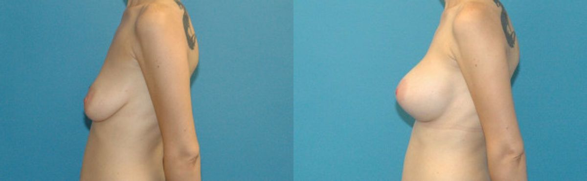 Breast Augmentation & Lift #18 - Before and After