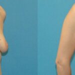 Breast Augmentation & Lift #18 - Before and After