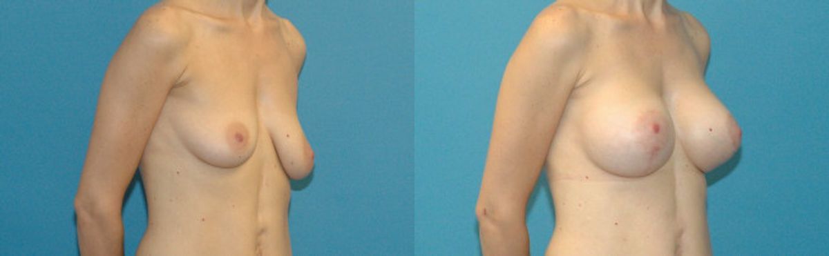 Breast Augmentation & Lift #18 - Before and After