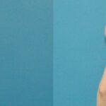 Breast Augmentation & Lift #18 - Before and After