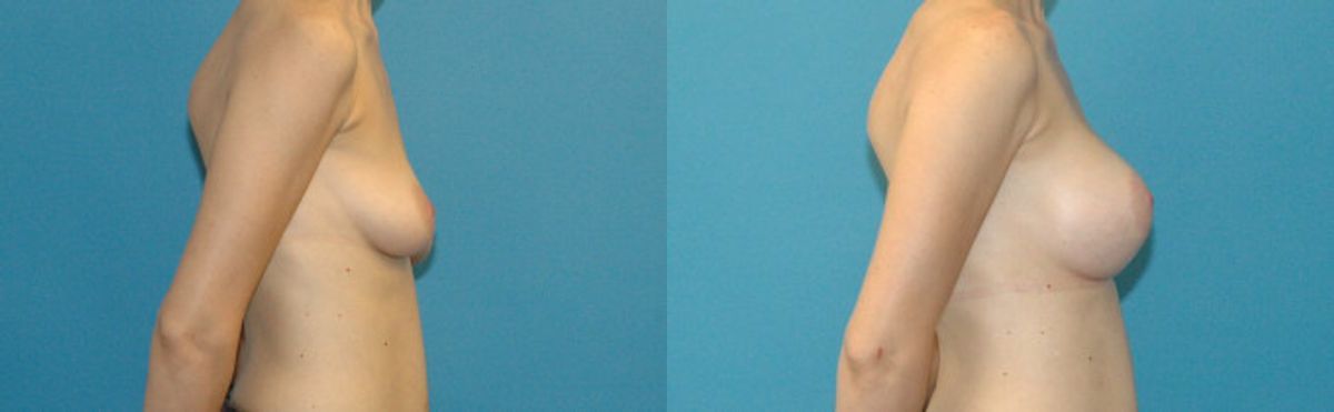 Breast Augmentation & Lift #18 - Before and After