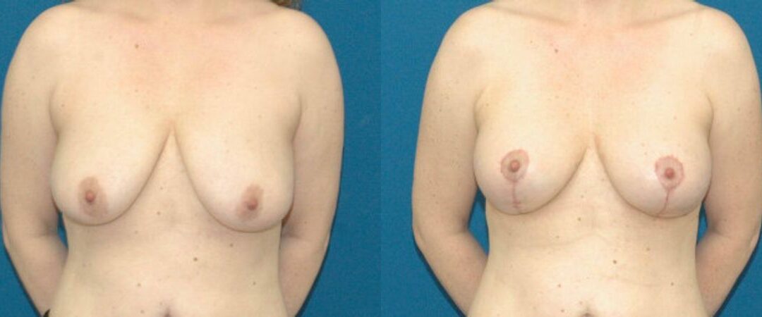 Breast Augmentation & Lift #19