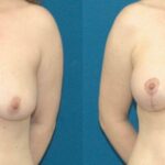Breast Augmentation & Lift #19 - Before and After