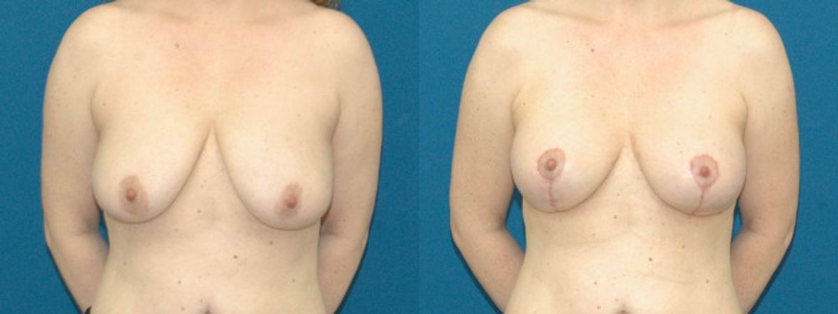 Breast Augmentation & Lift #19 - Before and After