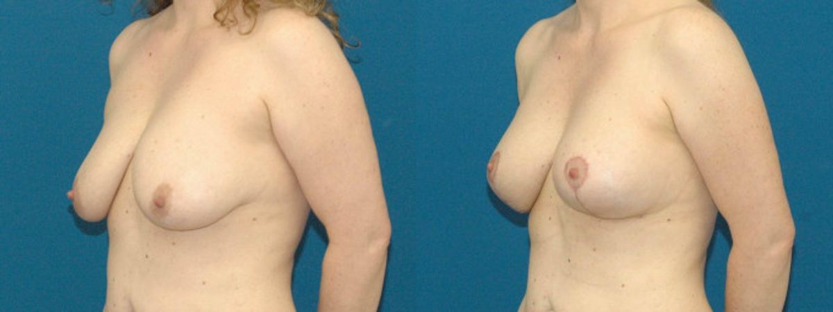 Breast Augmentation & Lift #19 - Before and After